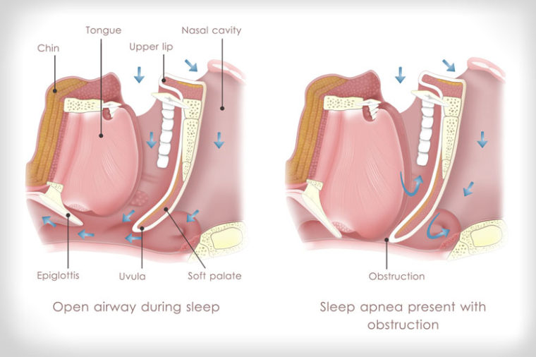 Sleep Apnea Anti-Snoring Device