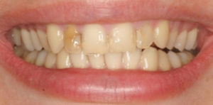 Porcelain Veneers Before Restoration