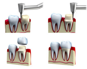 dental crown installation process