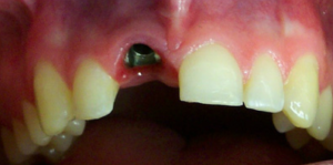Dental Implant Before Restoration