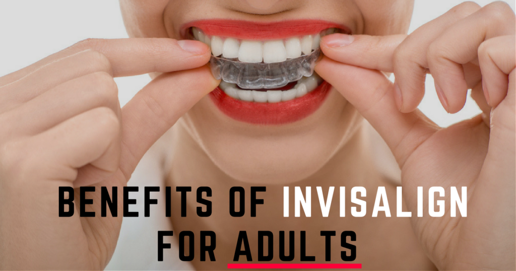 Benefits of Invisalign Treatment for Adults