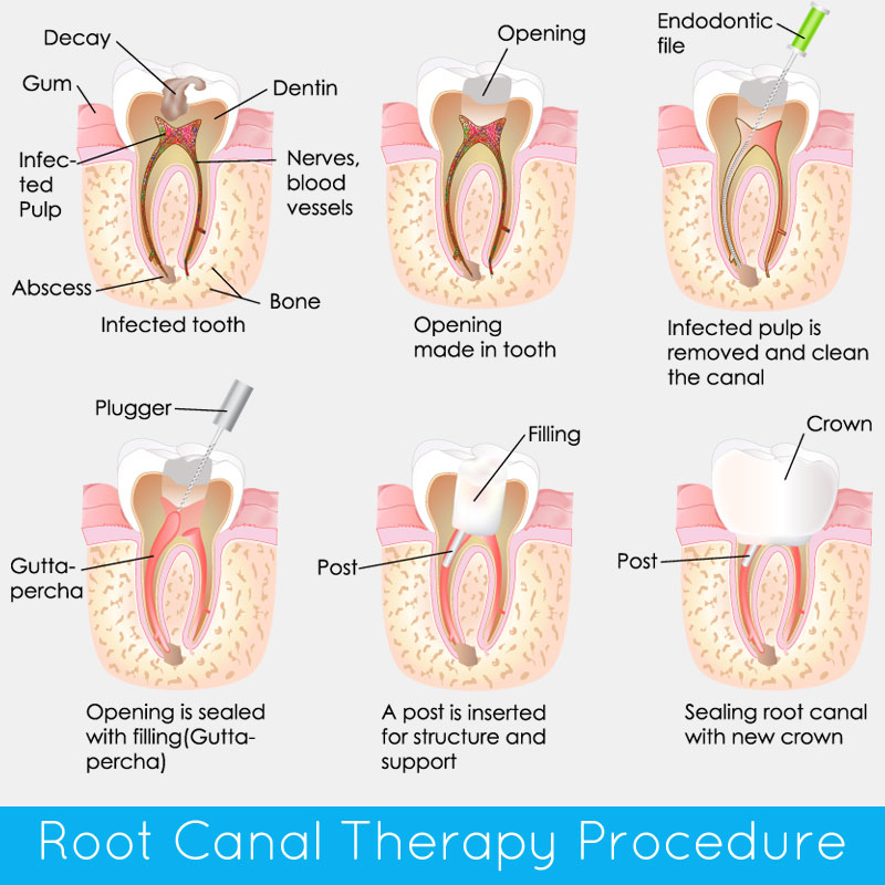 Root Canal Therapy Procedure