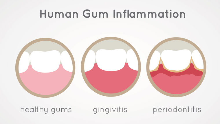Types of Human Gum Inflammation