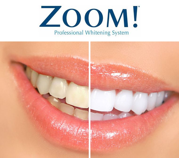 Zoom Professional Teeth Whitening